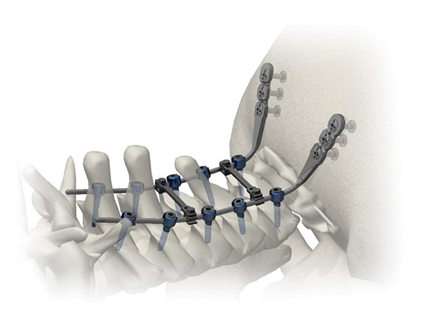 OccipitoCervical